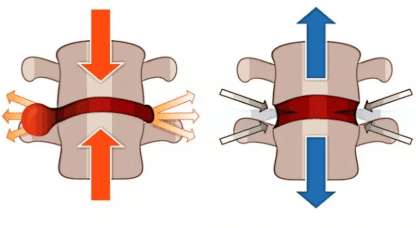 spine decompression